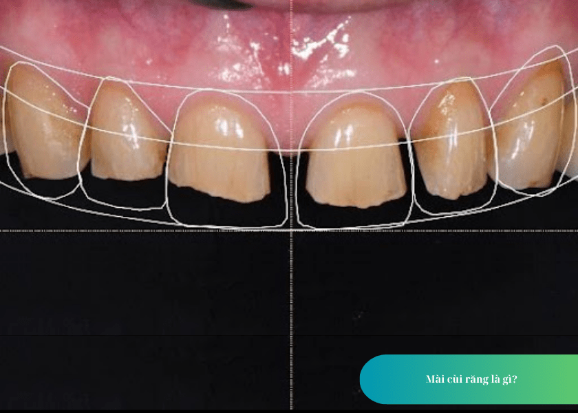 How much does teeth whitening cost 2 min 19
