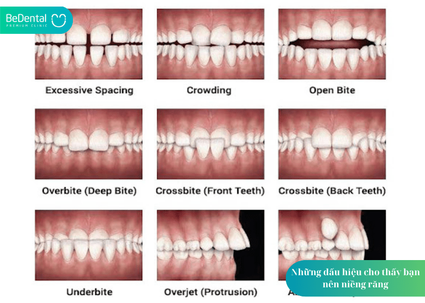 Khi nào nên niềng răng? 4 dấu hiệu cần biết để không bỏ lỡ thời điểm vàng 2 Khi nào nên niềng răng?