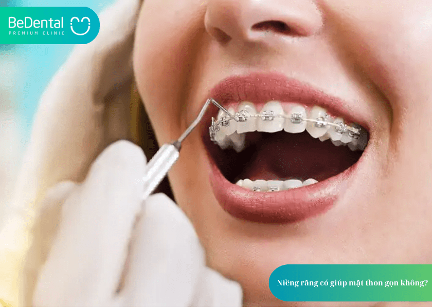 Niềng răng có giúp mặt thon gọn không?