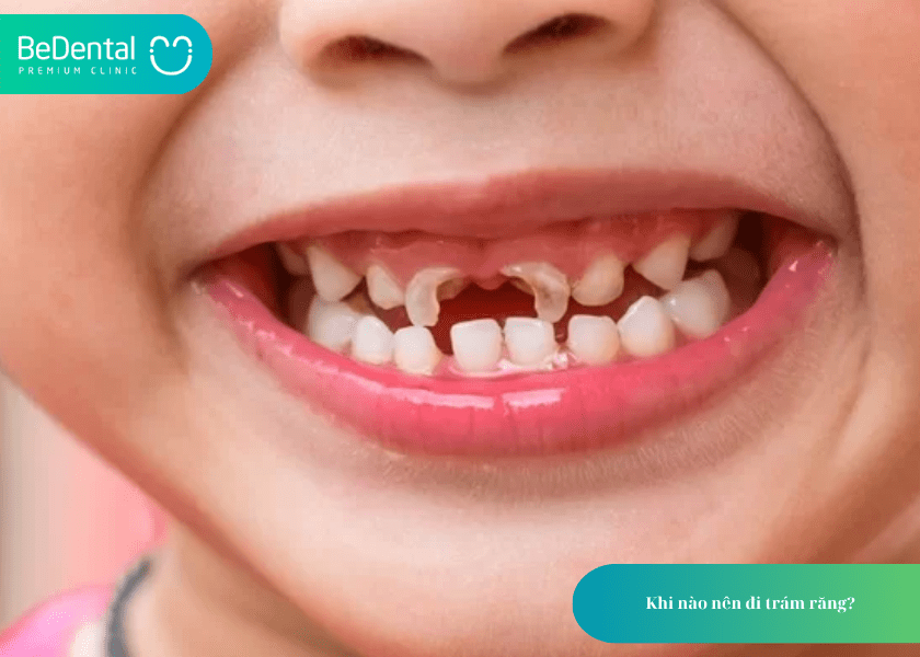 Có nên trám răng không? 4 lợi ích của trám răng bạn cần biết 2 How much does teeth whitening cost 2 min 22