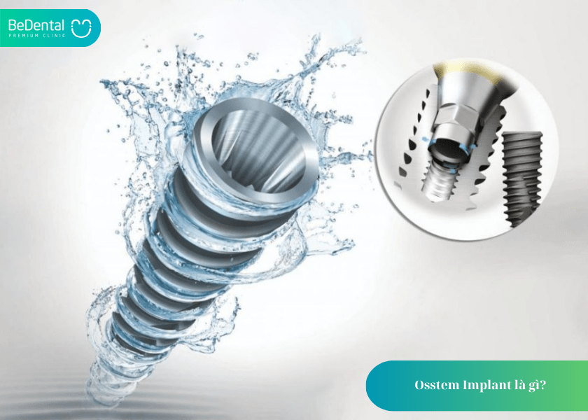 Osstem Implant – Giải pháp trồng răng tối ưu đến từ Hàn Quốc 2 Osstem Implant là gì?