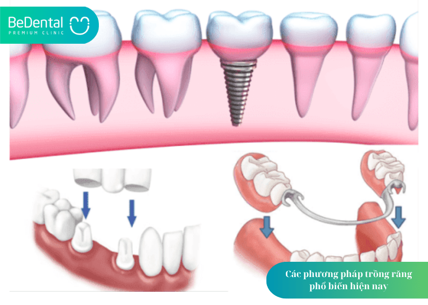 Trồng răng giá bao nhiêu? Cập nhật chi phí, bảng giá và 5 yếu tố quyết định 2 How much does teeth whitening cost 2 min 6