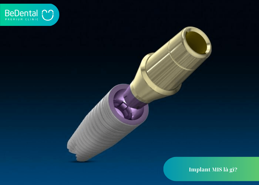 Implant MIS là gì? 5 điều quan trọng bạn cần biết trước khi lựa chọn 2 Implant MIS là gì?