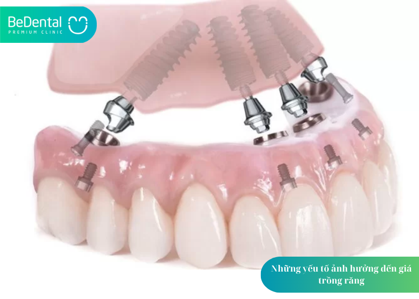 Trồng răng giá bao nhiêu? Cập nhật chi phí, bảng giá và 5 yếu tố quyết định 6 How much does teeth whitening cost 2