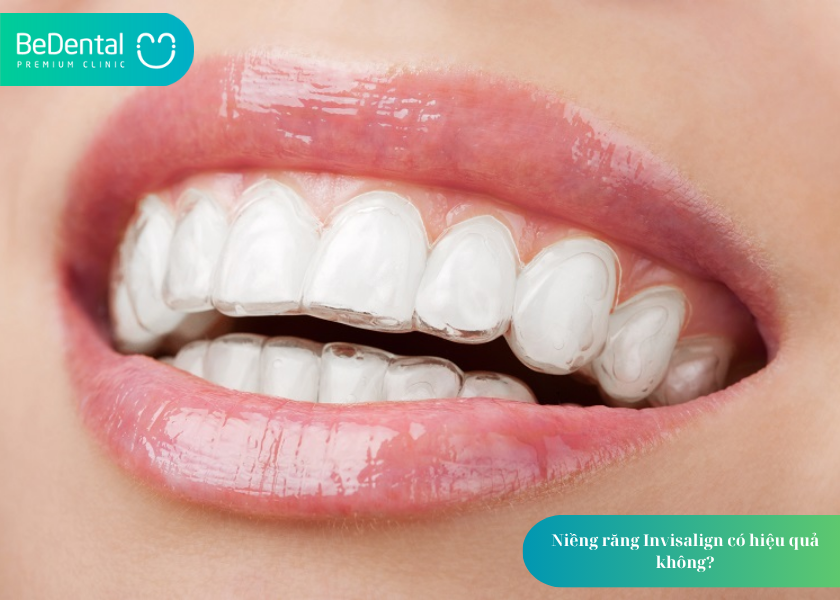 Niềng răng Invisalign có hiệu quả không? Góc nhìn chuyên môn và trải nghiệm thực tế 4 How much does teeth whitening cost 20