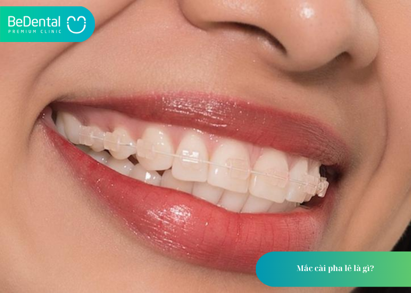 Niềng Răng Mắc Cài Pha Lê: Giải Pháp Chỉnh Nha Thẩm Mỹ Và Hiệu Quả 2 Niềng răng mắc cài pha lê