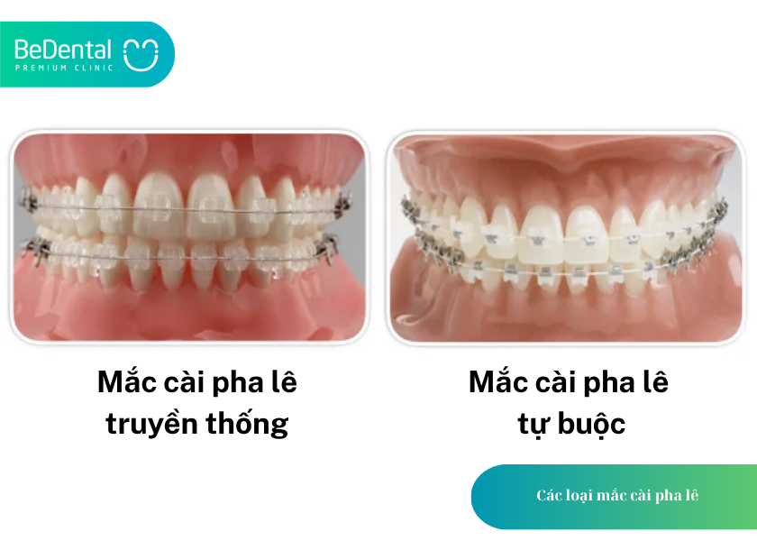 Niềng Răng Mắc Cài Pha Lê: Giải Pháp Chỉnh Nha Thẩm Mỹ Và Hiệu Quả 3 How much does teeth whitening cost 26