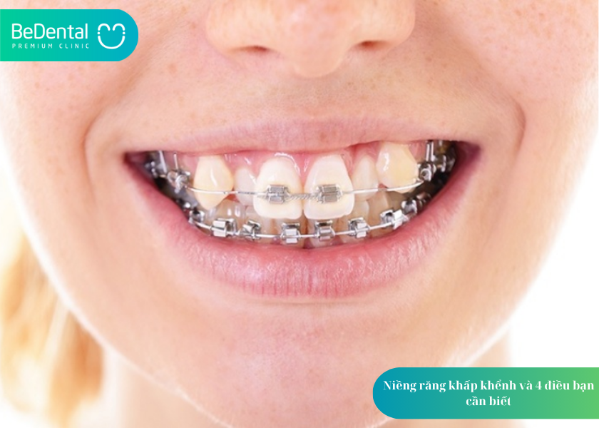 niềng răng khấp khểnh