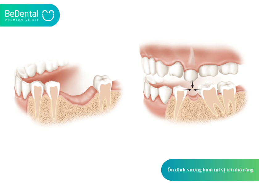 How much does teeth whitening cost 3 min 11