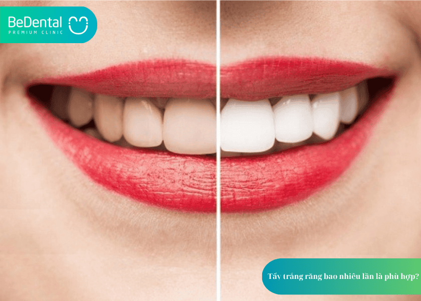Có nên tẩy trắng răng nhiều lần? Hiểu đúng để bảo vệ nụ cười khỏe đẹp 3 How much does teeth whitening cost 3 min 12