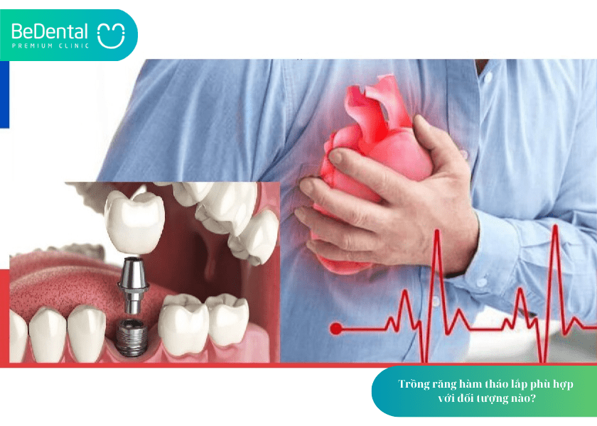 Bộ răng giả: Giải pháp phục hình linh hoạt và tiết kiệm cho người mất răng 4 How much does teeth whitening cost 3 min 15