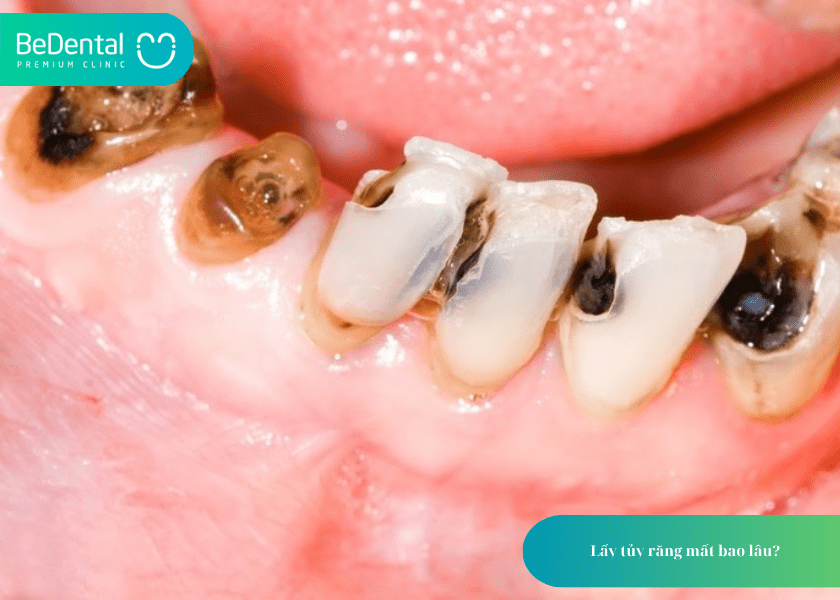 How much does teeth whitening cost 3 min 17