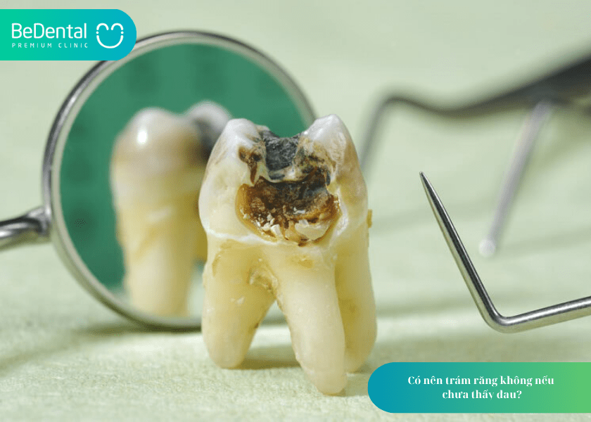 Có nên trám răng không? 4 lợi ích của trám răng bạn cần biết 3 How much does teeth whitening cost 3 min 22