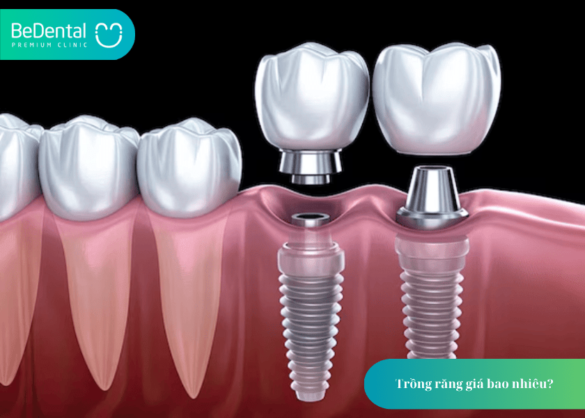 Trồng răng giá bao nhiêu? Cập nhật chi phí, bảng giá và 5 yếu tố quyết định 3 How much does teeth whitening cost 3 min 6