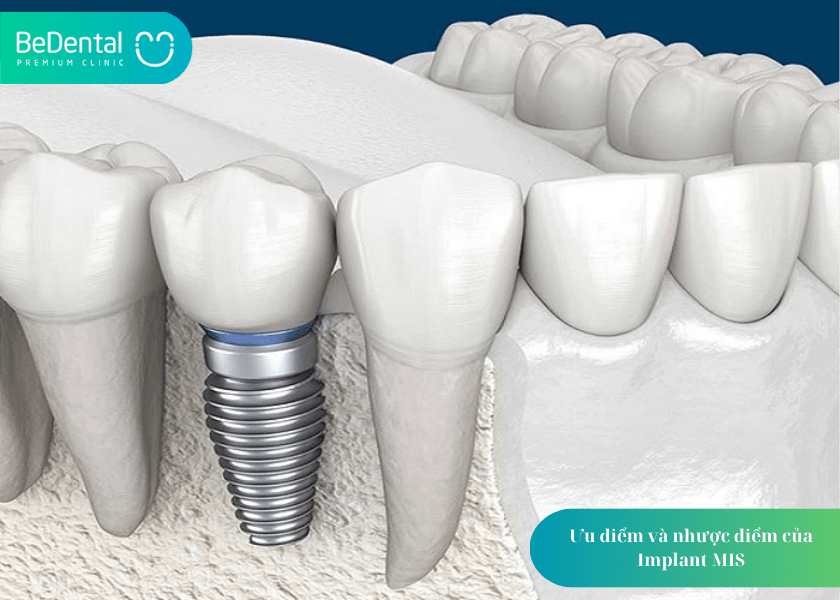 Implant MIS là gì? 5 điều quan trọng bạn cần biết trước khi lựa chọn 3 How much does teeth whitening cost 3 min