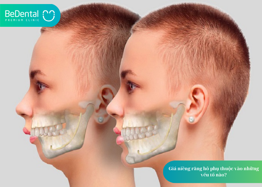 Giá niềng răng hô và 3 yếu tố ảnh hưởng 2 Giá niềng răng hô