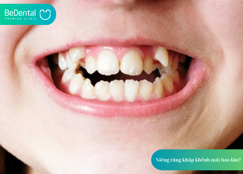 Niềng răng khấp khểnh và 4 điều bạn cần biết 3 How much does teeth whitening cost 4 2
