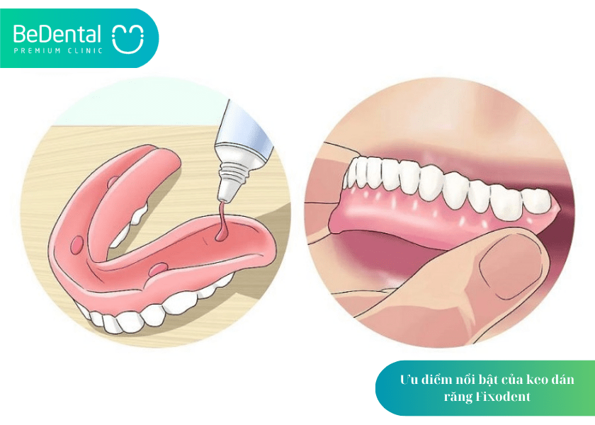 Fixodent là gì? Giải pháp keo dán răng được ưa chuộng hàng đầu hiện nay 4 How much does teeth whitening cost 4 min 1