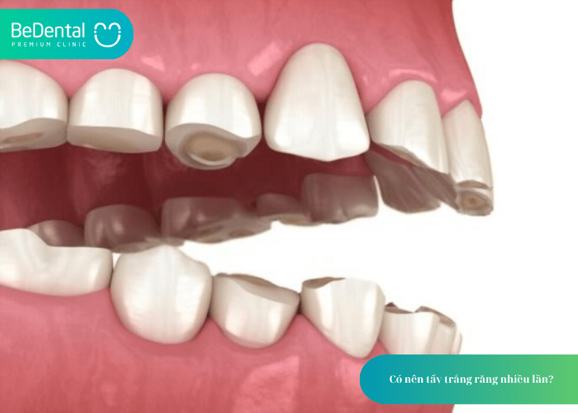 Có nên tẩy trắng răng nhiều lần? Hiểu đúng để bảo vệ nụ cười khỏe đẹp 4 How much does teeth whitening cost 4 min 10