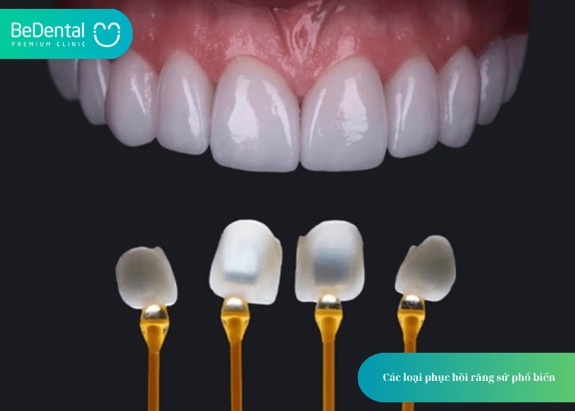 How much does teeth whitening cost 4 min 11