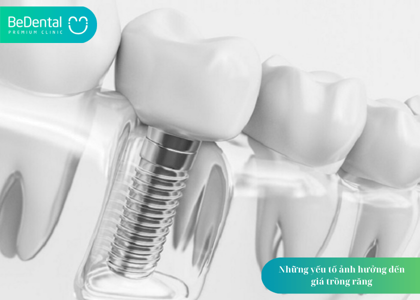 Trồng răng giá bao nhiêu? Cập nhật chi phí, bảng giá và 5 yếu tố quyết định 5 How much does teeth whitening cost 4 min 5
