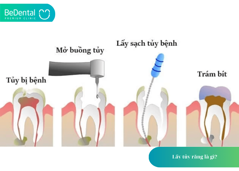 Lấy tủy răng mấy lần?