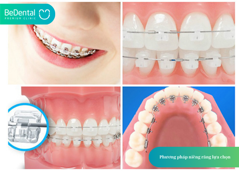 Giá niềng răng hô và 3 yếu tố ảnh hưởng 3 How much does teeth whitening cost 5 1