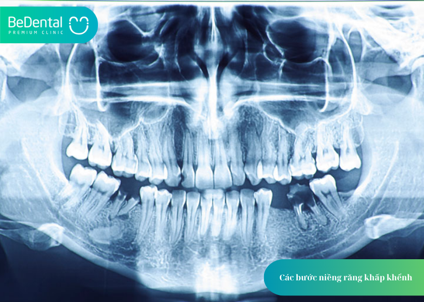 Niềng răng khấp khểnh và 4 điều bạn cần biết 4 How much does teeth whitening cost 5 2