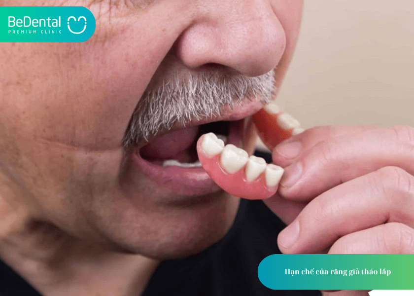 Bộ răng giả: Giải pháp phục hình linh hoạt và tiết kiệm cho người mất răng 6 How much does teeth whitening cost 5 min 12