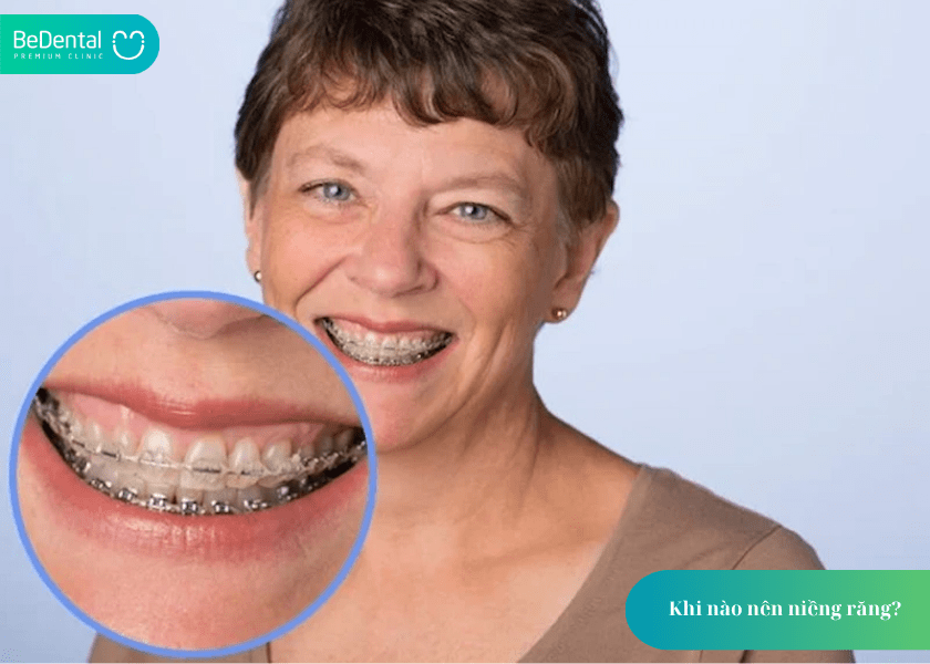 Khi nào nên niềng răng? 4 dấu hiệu cần biết để không bỏ lỡ thời điểm vàng 5 How much does teeth whitening cost 5 min 2