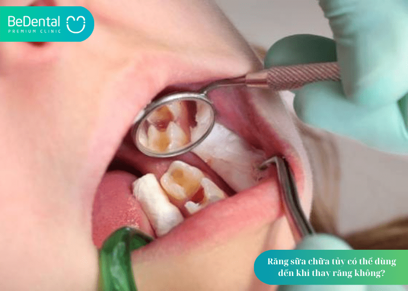 Chữa tủy răng sữa: Vì sao cần thiết và nên thực hiện thế nào để đảm bảo sức khỏe răng miệng lâu dài cho trẻ? 4 How much does teeth whitening cost 5 min 6