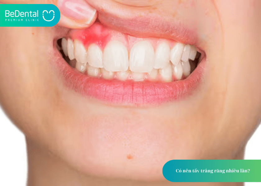 Có nên tẩy trắng răng nhiều lần? Hiểu đúng để bảo vệ nụ cười khỏe đẹp 5 How much does teeth whitening cost 5 min 9