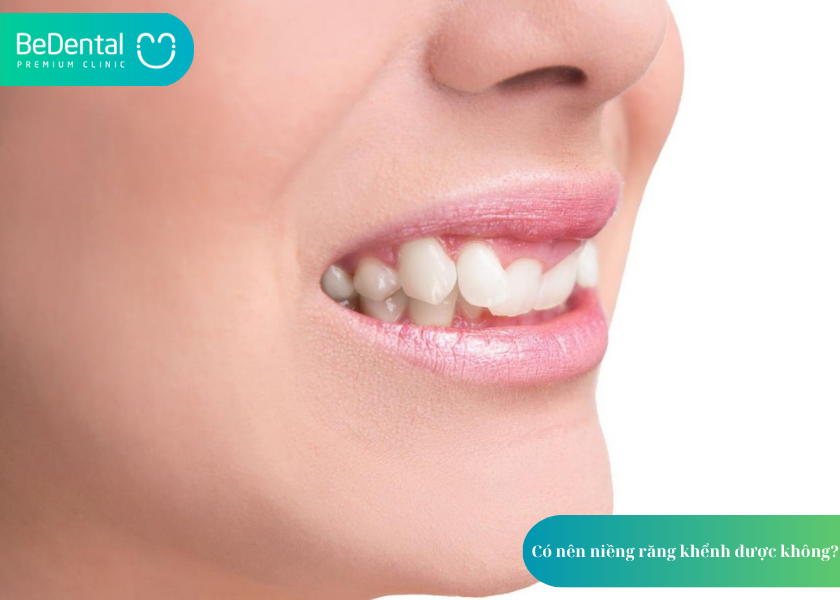 Niềng Răng Khểnh: Mất Bao Lâu & Chi Phí 2 How much does teeth whitening cost 6 2