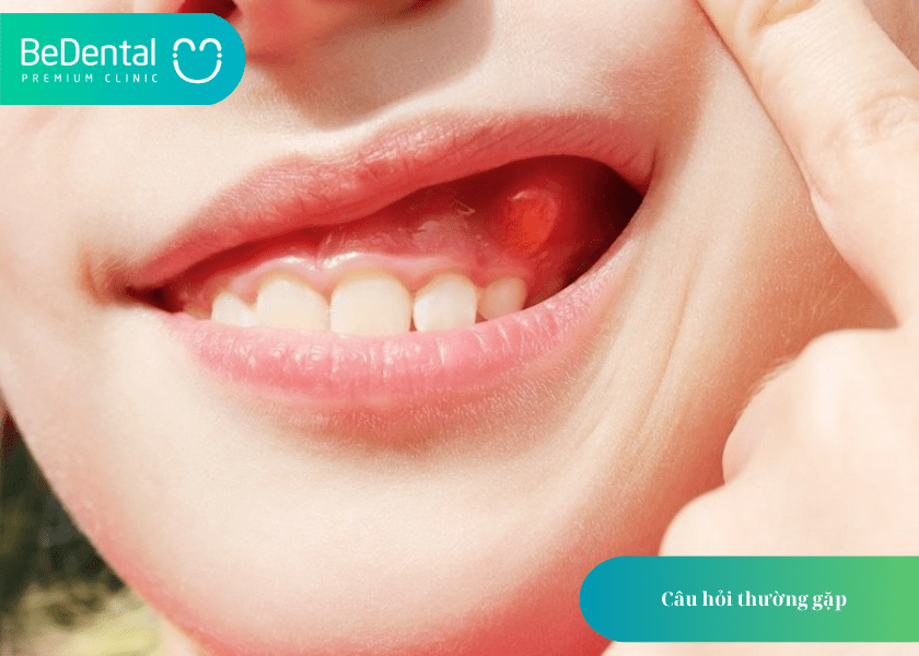 Fixodent là gì? Giải pháp keo dán răng được ưa chuộng hàng đầu hiện nay 6 Fixodent là gì?