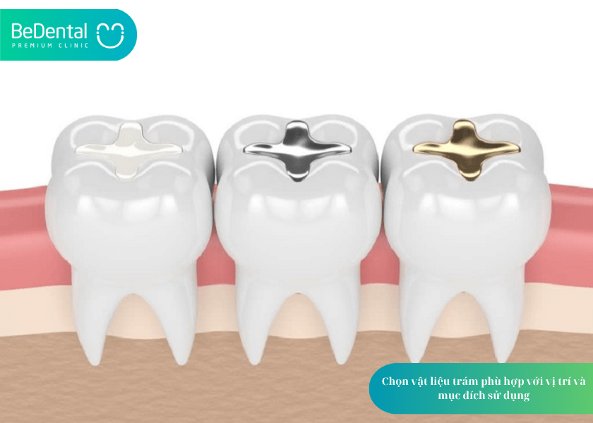 Có nên trám răng không? 4 lợi ích của trám răng bạn cần biết 5 How much does teeth whitening cost 6 min 13