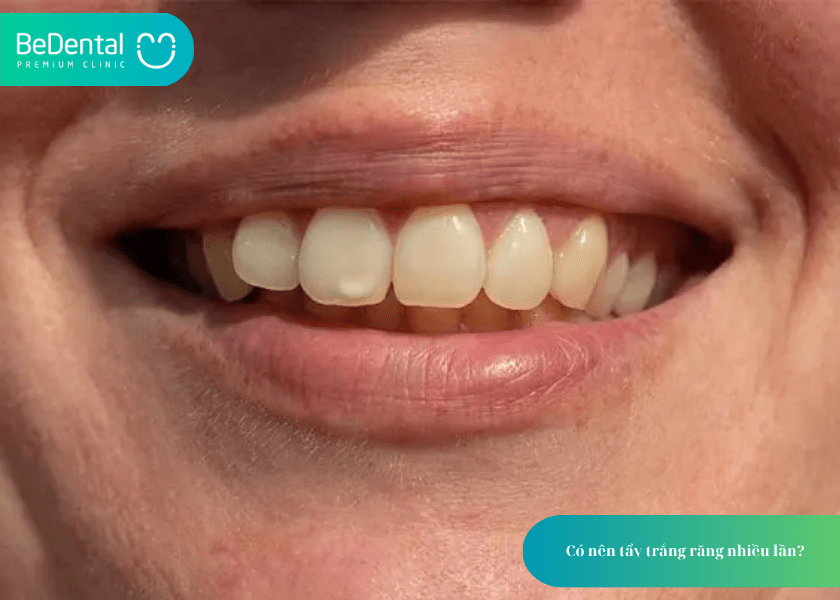 Có nên tẩy trắng răng nhiều lần? Hiểu đúng để bảo vệ nụ cười khỏe đẹp 6 How much does teeth whitening cost 6 min 7