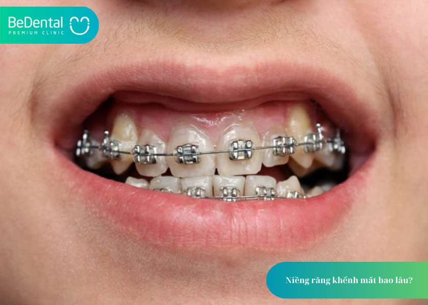 Niềng Răng Khểnh: Mất Bao Lâu & Chi Phí 3 How much does teeth whitening cost 7 2