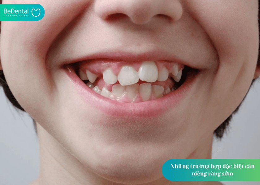 Khi nào nên niềng răng? 4 dấu hiệu cần biết để không bỏ lỡ thời điểm vàng 7 How much does teeth whitening cost 7 min 1