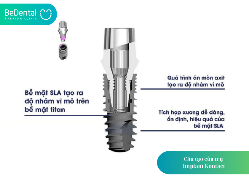 Trụ Implant Kontact và 4 điều cần biết 2 How much does teeth whitening cost 7 min
