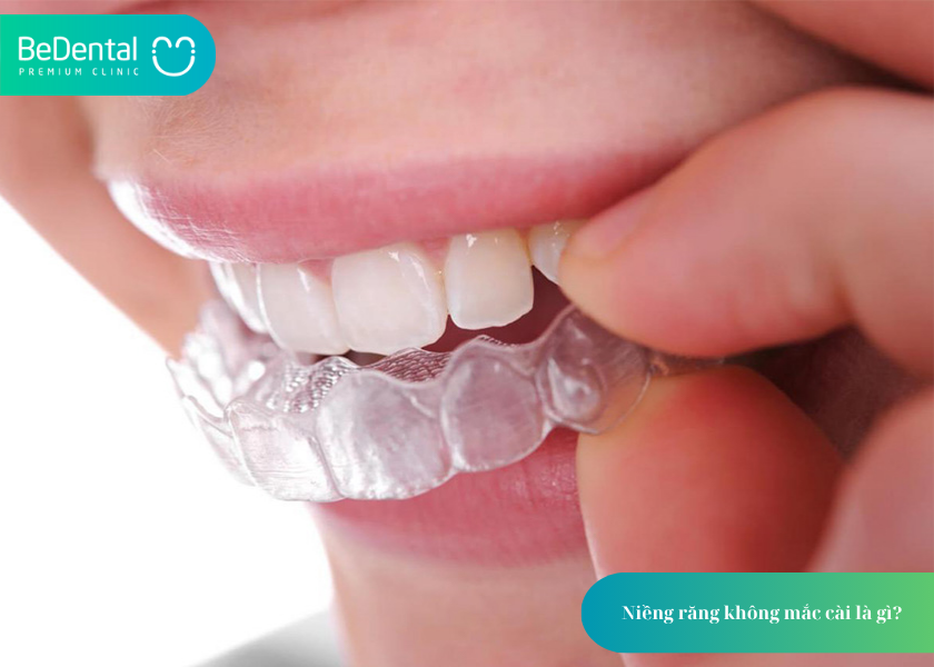 Niềng Răng Không Mắc Cài: Giải Pháp Thẩm Mỹ Và Hiệu Quả Trong Chỉnh Nha Hiện Đại 2 Niềng răng không mắc cài là gì?