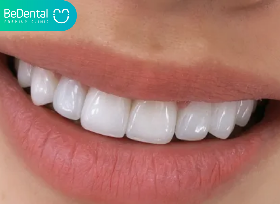 Ưu nhược điểm của việc bọc răng sứ 3 Ưu nhược điểm của việc bọc răng sứ