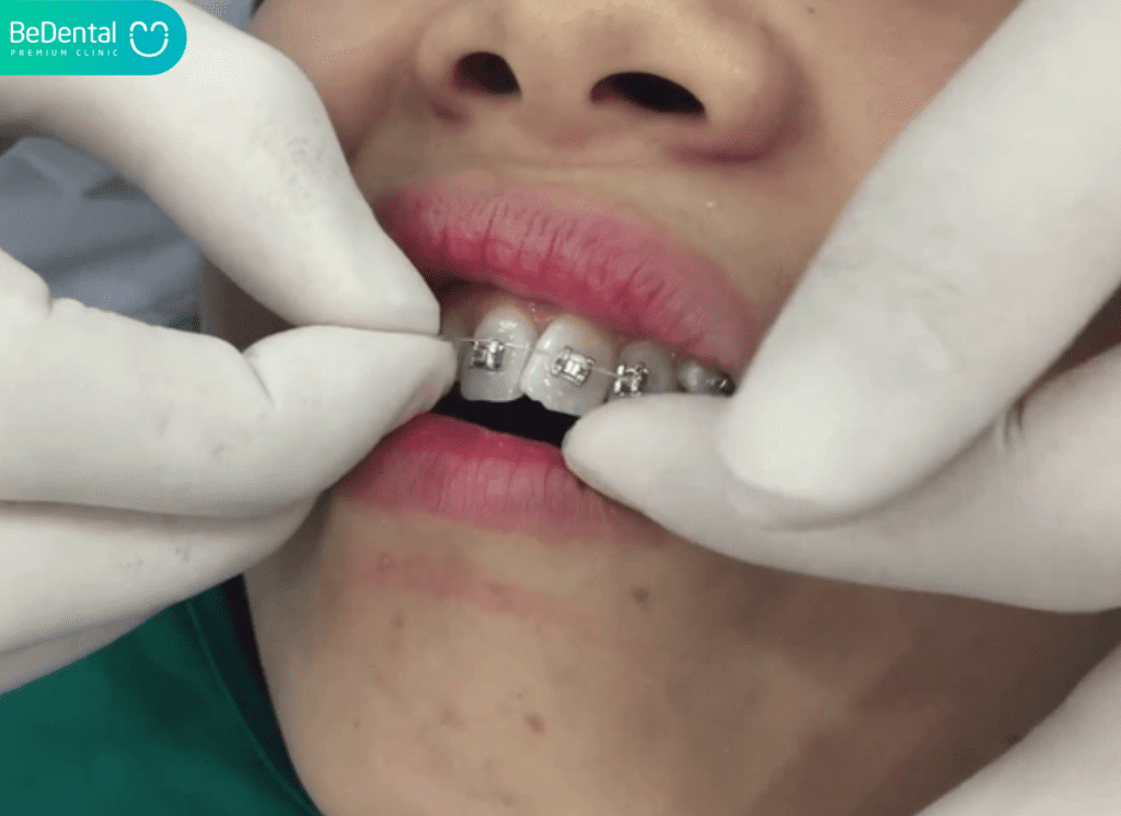 Niềng Răng Xong Bị Chạy Răng: Nguyên Nhân, Cách Khắc Phục Và Phòng Ngừa Hiệu Quả 3 Nieng rang xong co bi chay khong 2