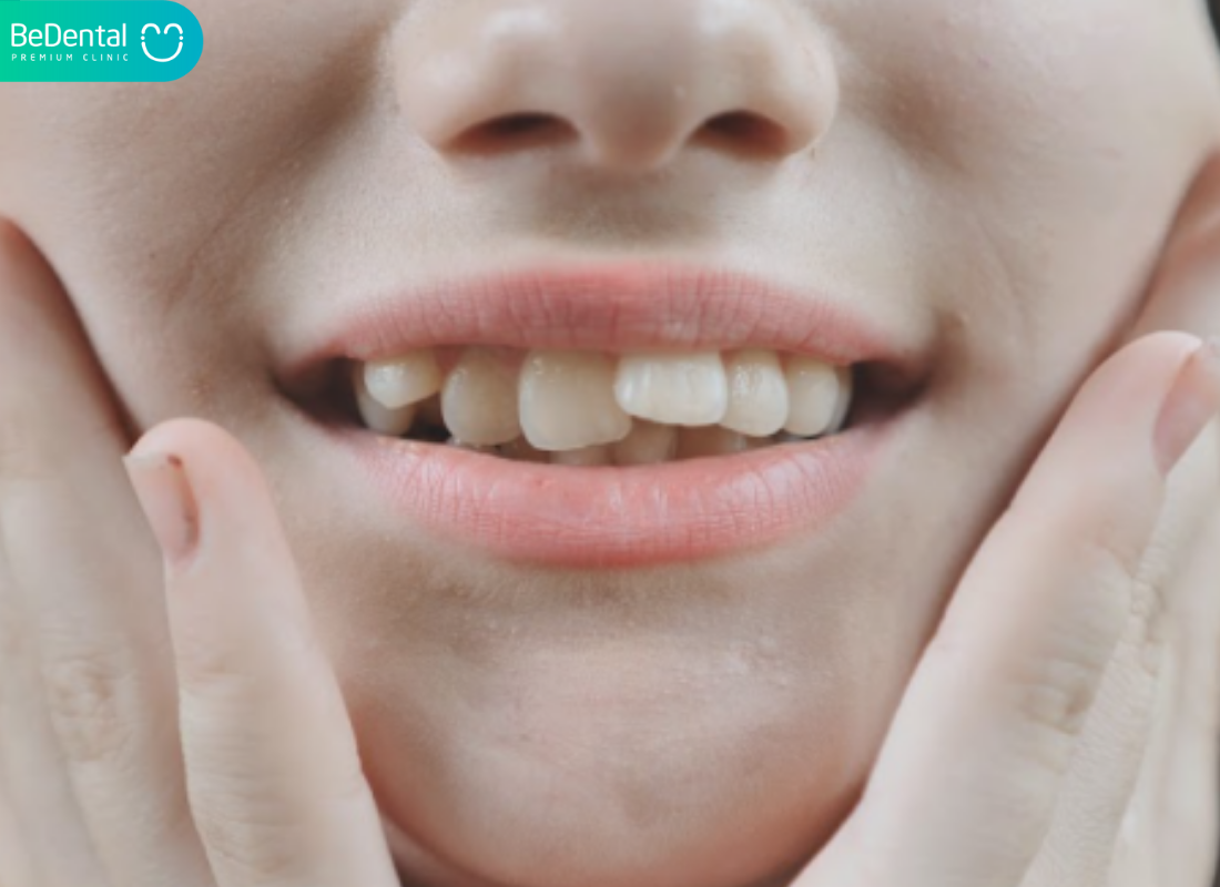 Niềng răng xong có bị chạy không