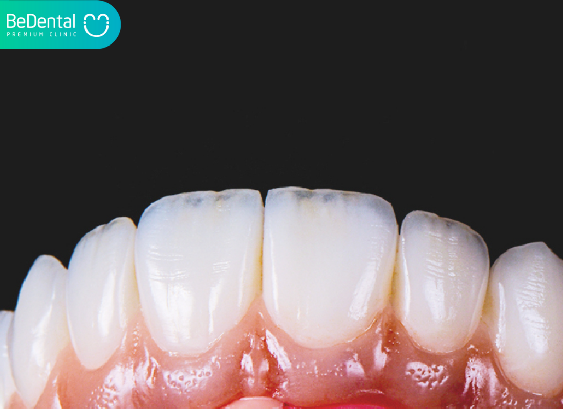 Răng sứ ht smile