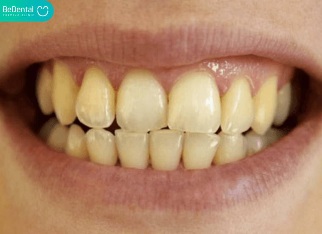Răng Sứ Có Bị Ố Vàng Không? Giải Đáp Chi Tiết Từ A Đến Z 2 răng sứ có bị ố vàng không