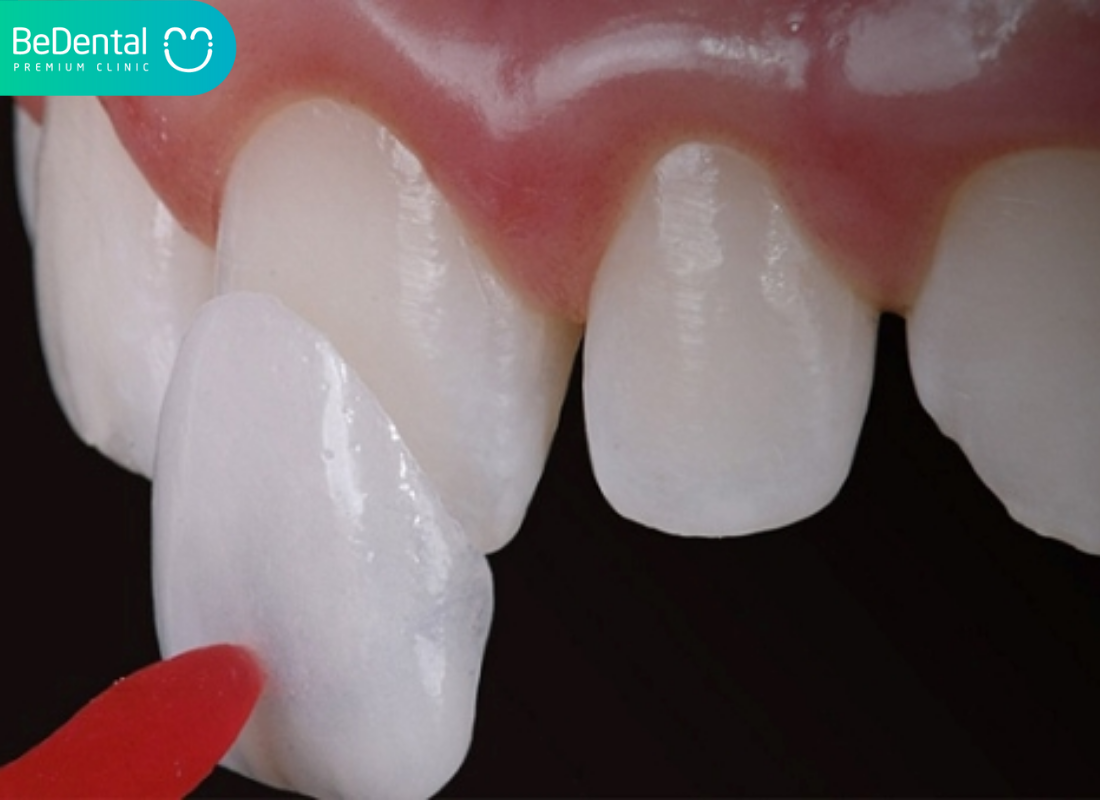 Tác hại của dán răng sứ khi thực hiện sai kỹ thuật 3 Tác hại của dán răng sứ