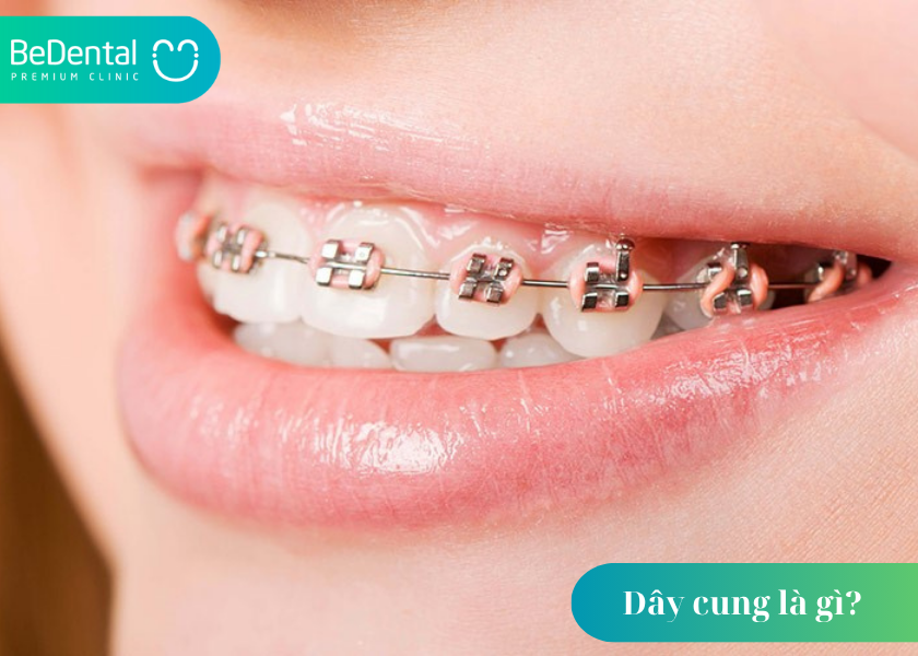 Dây cung là gì? Tìm hiểu chi tiết về vai trò của dây niềng trong chỉnh nha 3 Dây cung là gì ?