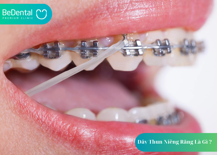 Dây Thun Niềng Răng Là Gì