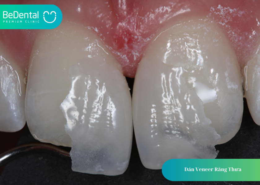 Dán Veneer Răng Thưa