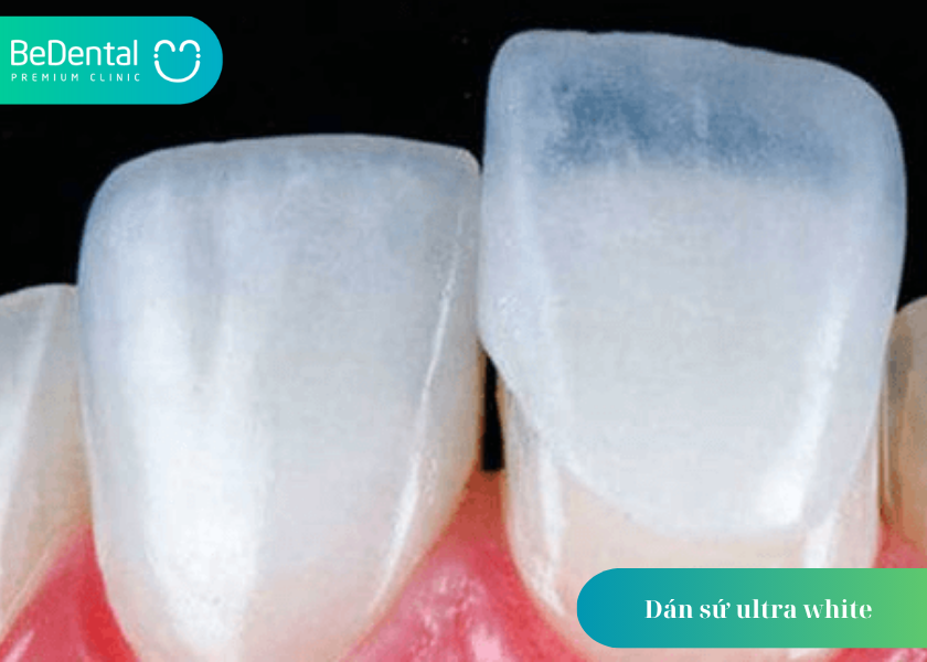 Dán sứ ultra white
